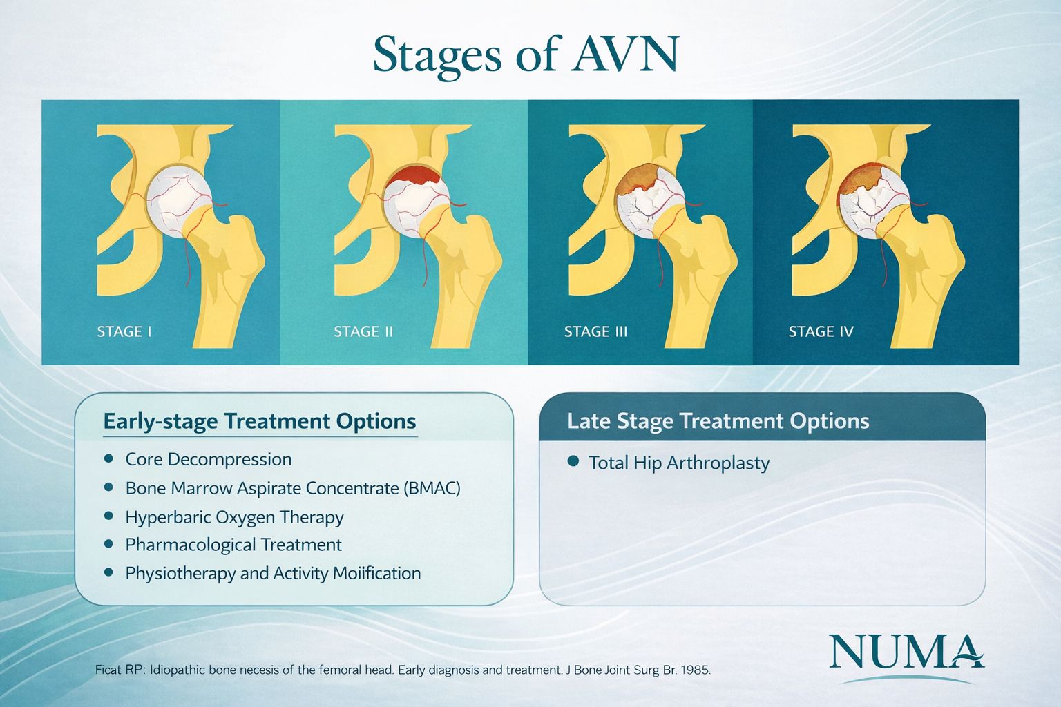 Stages of avascular necrosis of the femoral head showing Ficat Stage I, Stage II, Stage III, and Stage IV.