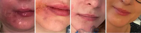 An image showing vascular occlusion following a lip filler