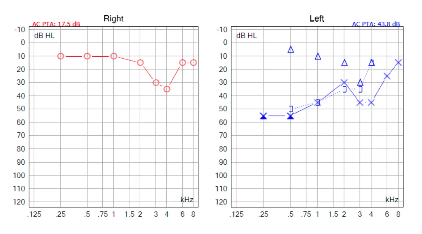 Audiology test result