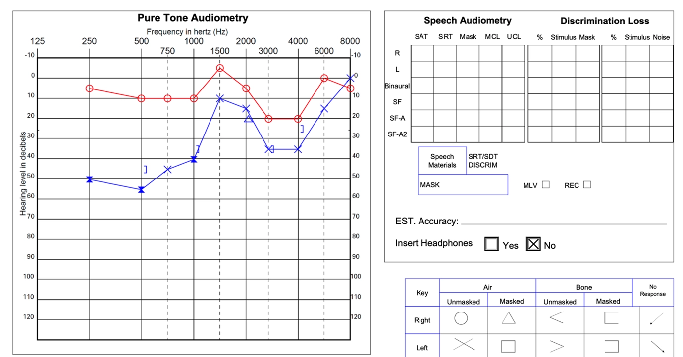 Pure tone audiometry graph