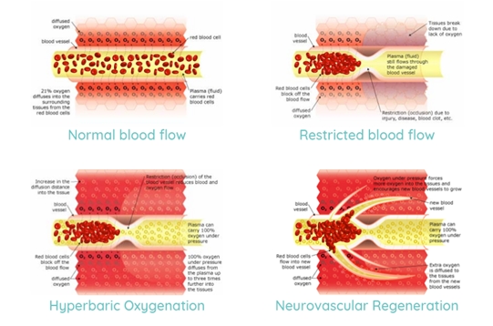 Hyperbaric Oxygenation