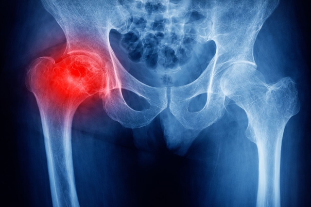 X-ray image of the pelvis and both hip joints, with the right hip highlighted in red to indicate pain, inflammation, or an area of concern