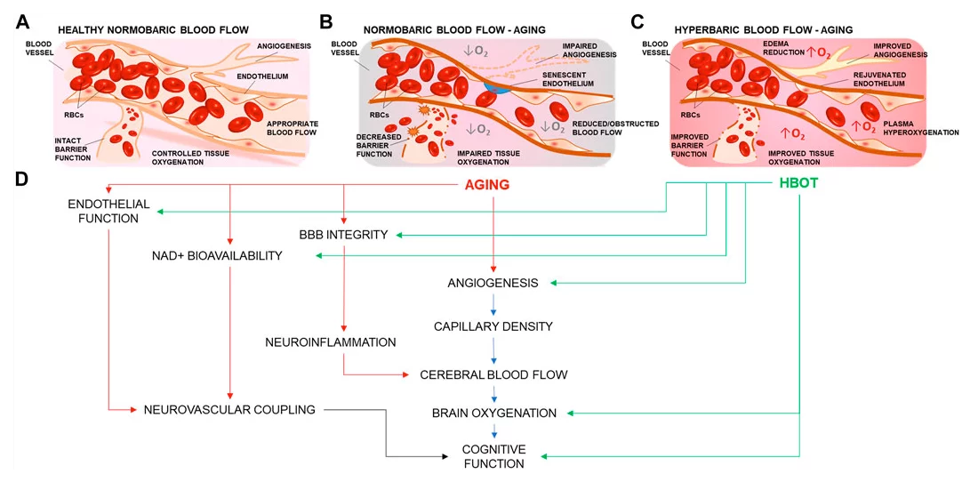 An illustration of the cerebrovascular effects of hyperbaric oxygen treatment